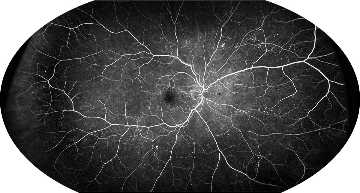Angiographie à la Fluorescéine et ICG