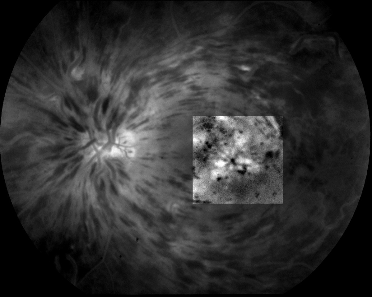 Occlusions vasculaires rétiniennes : OACR, OVCR