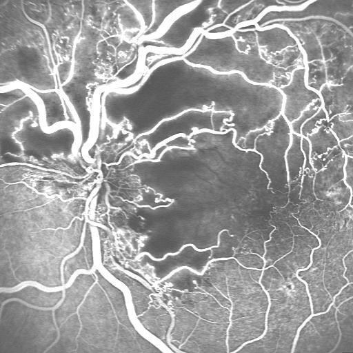 Occlusions vasculaires rétiniennes : OACR, OVCR