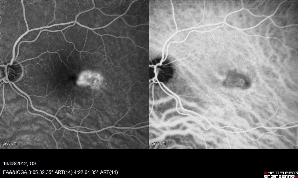 Angiographie à la Fluorescéine et ICG