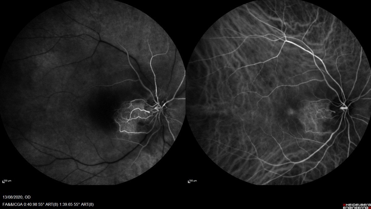 Occlusions vasculaires rétiniennes : OACR, OVCR