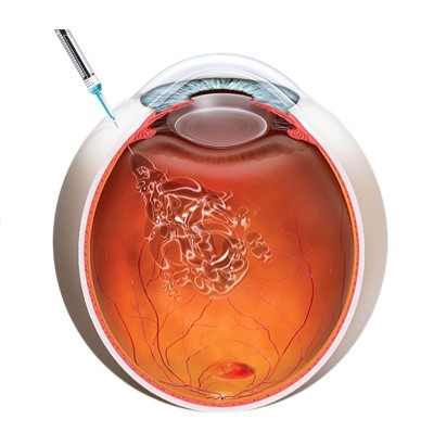 Injections intra vitréennes